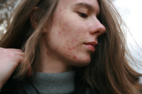 How to Treat Acne Without Damaging Your Skin